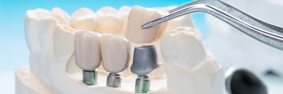 implant bagneux
